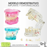 #0240 MODELODEMOSTRATIVO IMPLANTE Y ENFERMEDADES